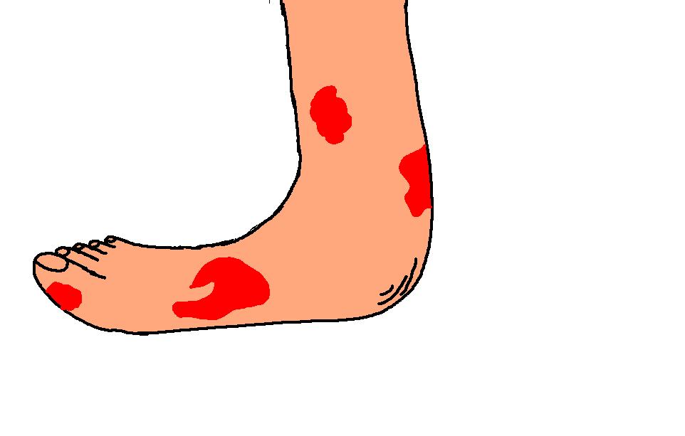 10 plagues of Egypt boils and sores